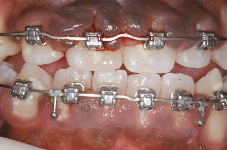 Before picture of Gingival Hyperplasia